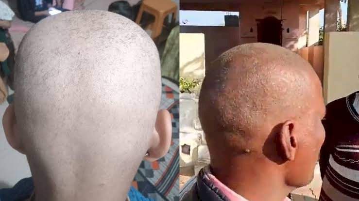 बुलढाण्यातील काही गावांमध्ये अचानक केसगळतीचे प्रमाण. तीनच दिवसात टक्कल पडत असल्याने भीतीचे वातावरण.